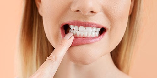 What Is Tooth Erosion and How Can You Prevent it?