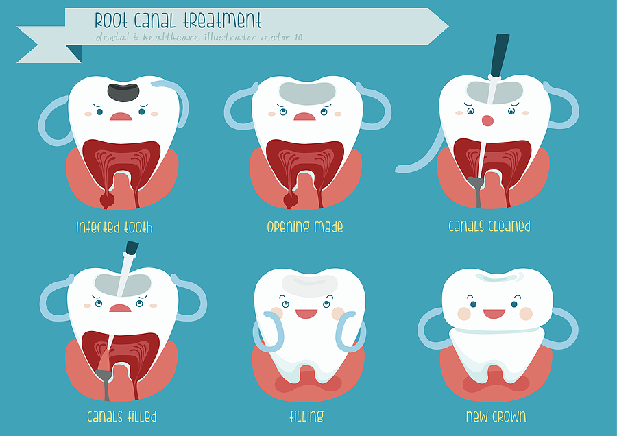 Root Canals: A Vital Solution for Tooth Preservation