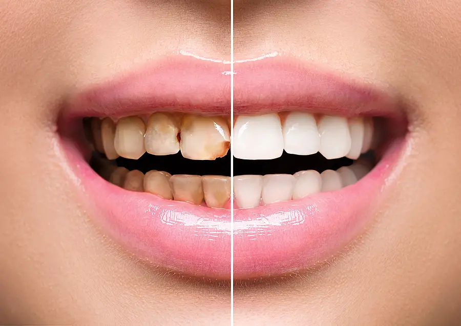 Revitalize Your Smile with Professional Teeth Whitening in Richmond, TX