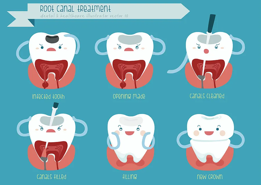 Root Canals: A Vital Solution for Tooth Preservation