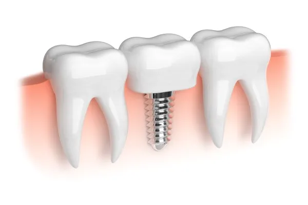3 Signs You Need Dental Implant Restoration