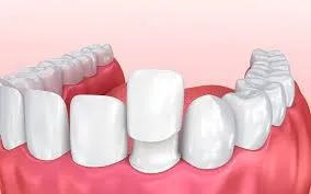 What Are Dental Veneers?